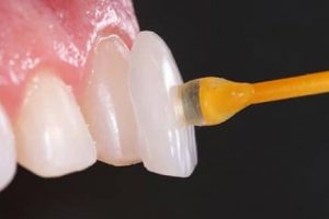 Lente Dental em Marataízes